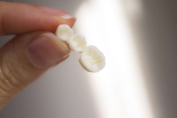 Bridges vs. Dental Implants: Which Is Better from Chesterfield Dentist in Chester, VA