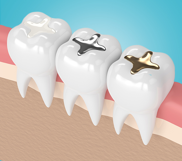 Chester Composite Fillings