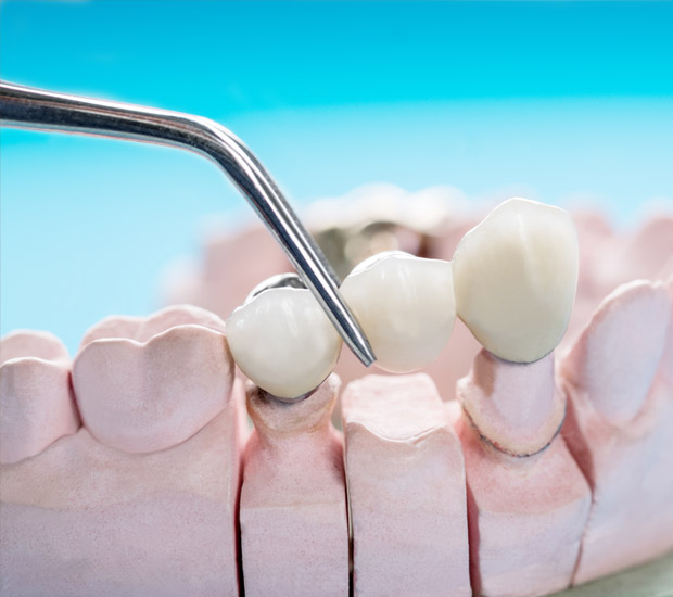 Chester Dental Bridges