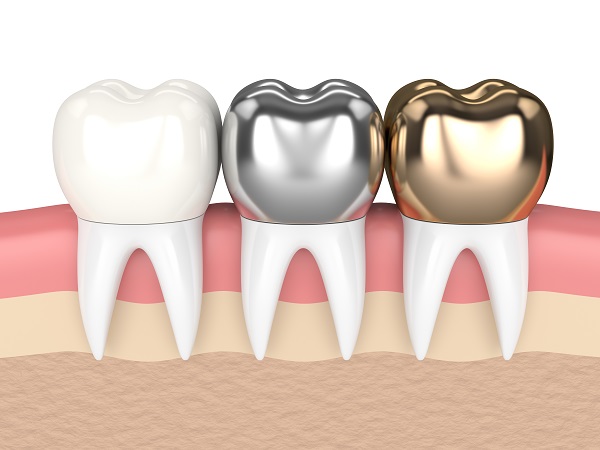 Tips For Choosing Your Dental Crown Material