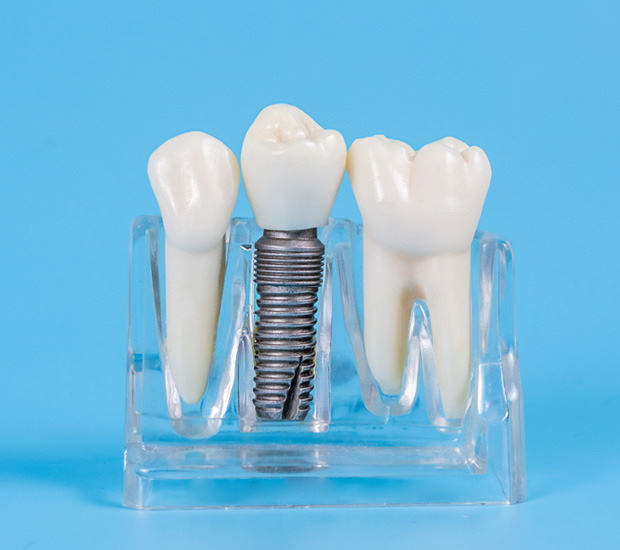 Chester Dental Implant Restoration
