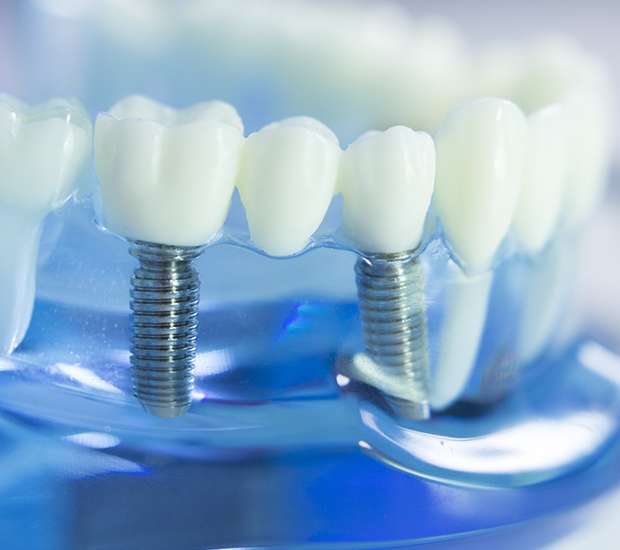 Chester Dental Implants