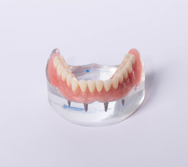 Chester Implant Supported Dentures