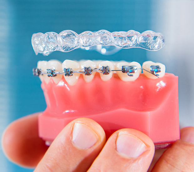Chester Invisalign vs Traditional Braces