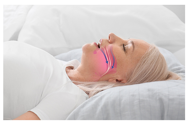 How A General Dentist Can Help If You Have Sleep Apnea